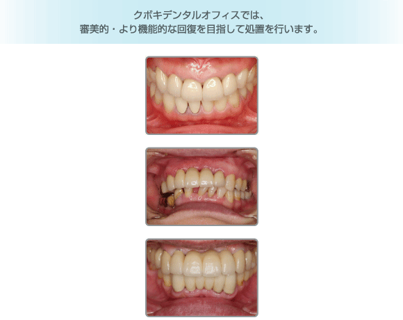 クボキデンタルオフィスでは、審美的・より機能的な回復を目指して処置を行います。