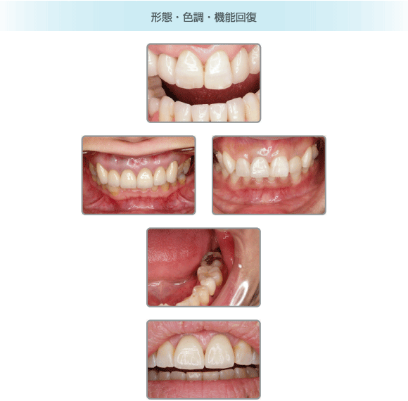 形態・色調・機能回復