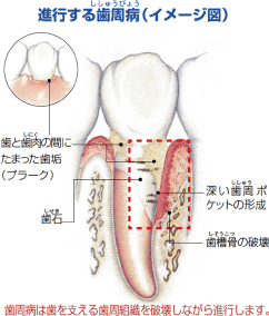 進行する歯周病（イメージ図）