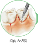 歯肉の切開