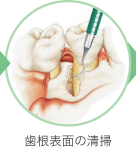 歯根表面の清掃